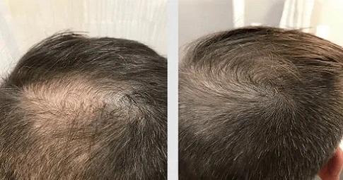Exosome Hair Therapy before and after