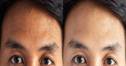 Glutathione injection before and after