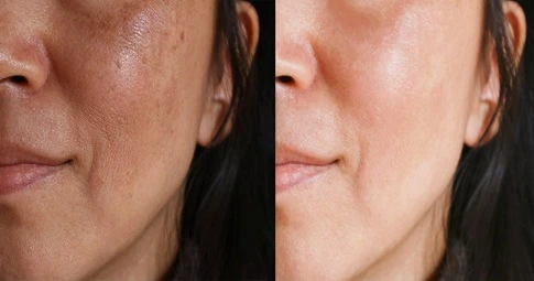 Glutathione injection before and after