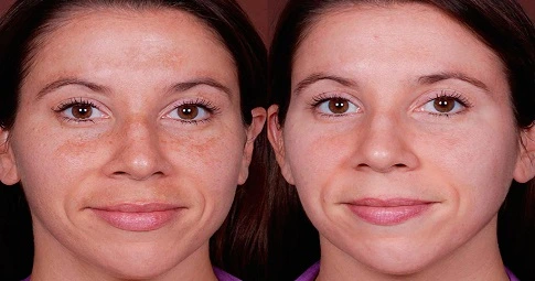 Glutathione injection before and after