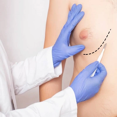 Gynaecomastia Surgery in Dubai