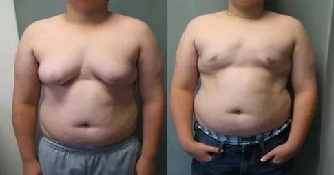 Gynaecomastia Surgery before and after