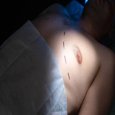 Gynaecomastia Surgery in Dubai