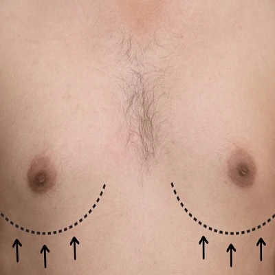 Gynaecomastia Surgery in Dubai
