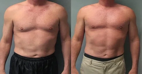Gynaecomastia Surgery before and after