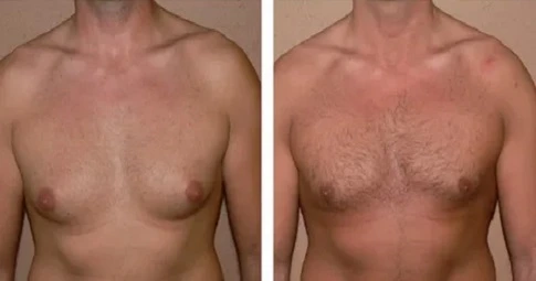 Gynaecomastia Surgery before and after