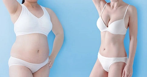 HD Liposuction before and after