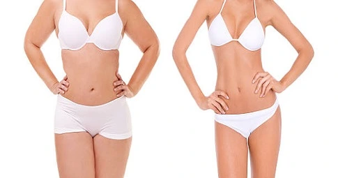 HD Liposuction before and after