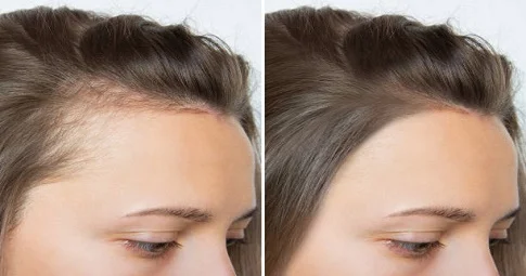 Hair Loss Treatment before and after