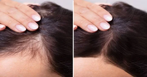 Hair Loss Treatment before and after