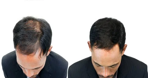 Hair Loss Treatment before and after