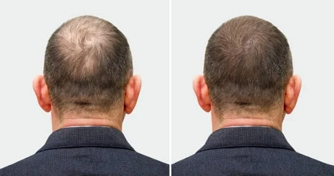 Hair Loss Treatment before and after