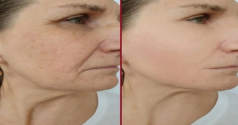 Laser photorejuvenation in Dubai
