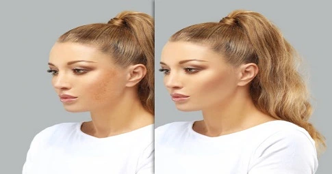 Laser photorejuvenation in Dubai