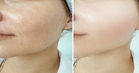 Laser photorejuvenation in Dubai
