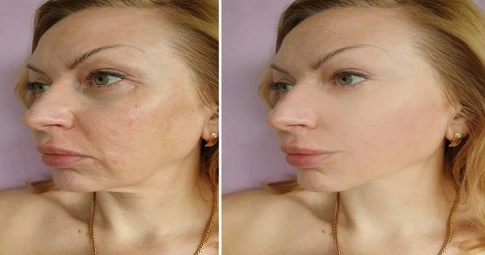 Laser photorejuvenation in Dubai