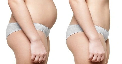 Lipomatic treatment before and after