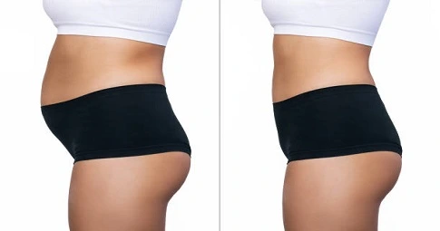 Lipomatic treatment before and after