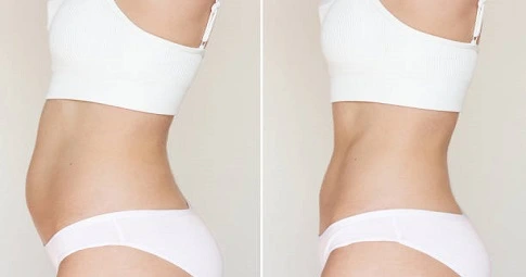 Lipomatic treatment before and after