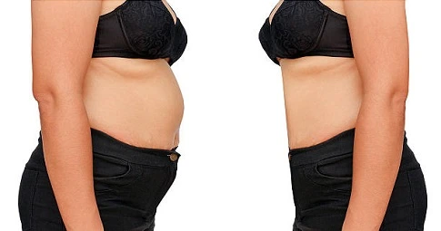 MILA Surgery before and after