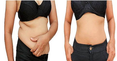 MILA Surgery before and after