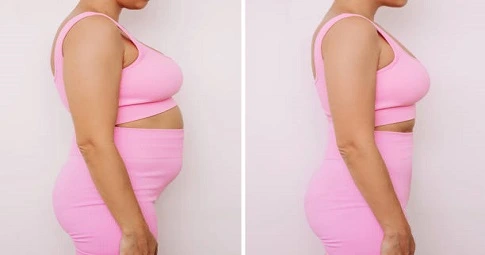 MILA Surgery before and after