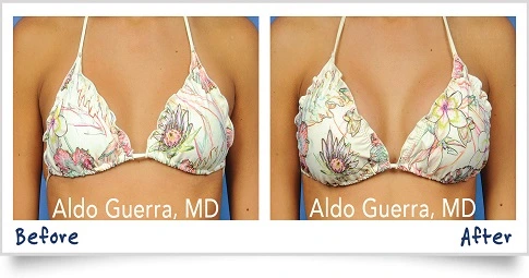 MacroLane Injection before and after