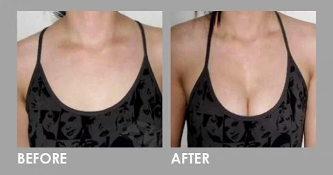 MacroLane Injection before and after