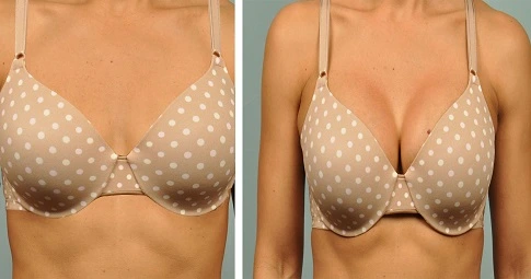 MacroLane Injection before and after