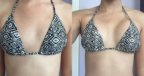 MacroLane Injection before and after