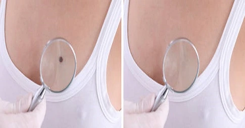 Mole Removal before and after