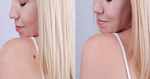 Mole Removal in Dubai