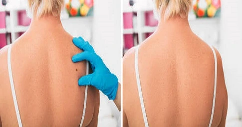 Mole Removal before and after