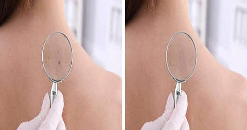 Mole Removal before and after