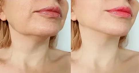 Neck Lift before and after