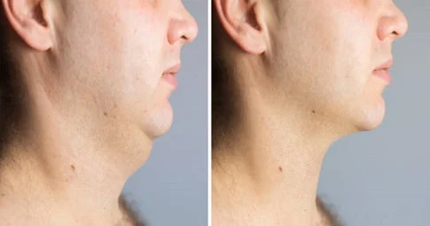 Neck Lift before and after