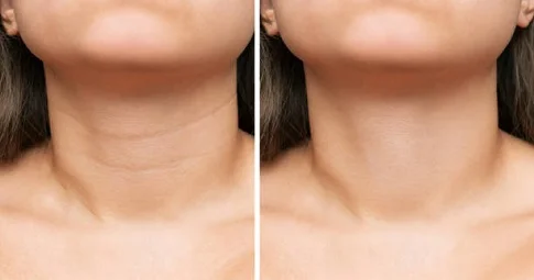 Neck Lift before and after