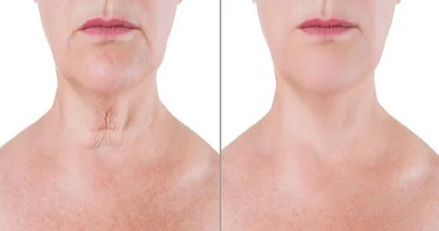Neck Lift before and after
