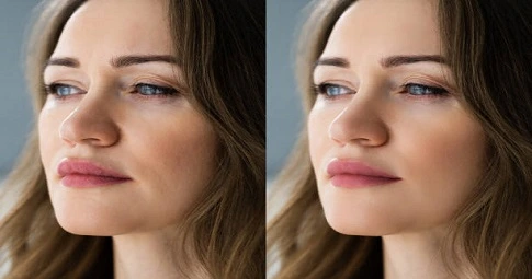 Cheek Filler Injections before and after