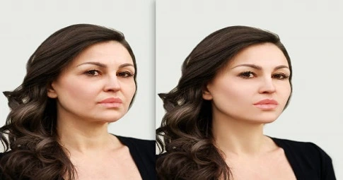 Cheek Filler Injections before and after