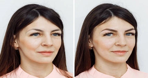 Cheek Filler Injections before and after