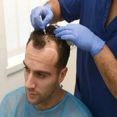 FUE Hair Transplant in Dubai