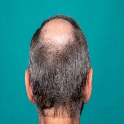 FUE Hair Transplant in Dubai