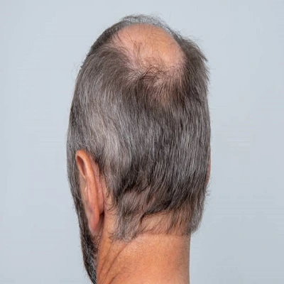 FUE Hair Transplant in Dubai