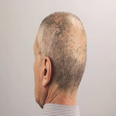 FUE Hair Transplant in Dubai