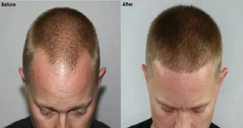 FUE Hair Transplant before and after