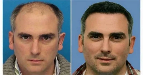 FUE Hair Transplant before and after