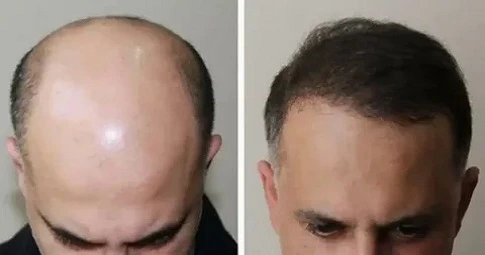 FUE Hair Transplant before and after