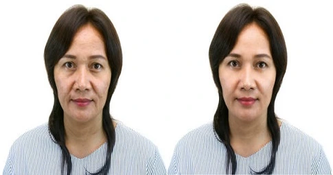 Fat Transfer Surgery before and after