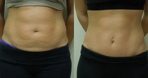 Fat Transfer Surgery before and after